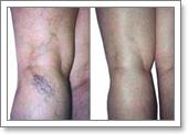 результаты склерозирования вен