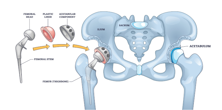 Протез тазобедренного сустава