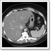 причины возникновения стеатогепатита печени