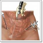 Лечение пельвиоперитонита