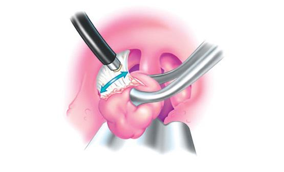Эндоскопическая аденотомия