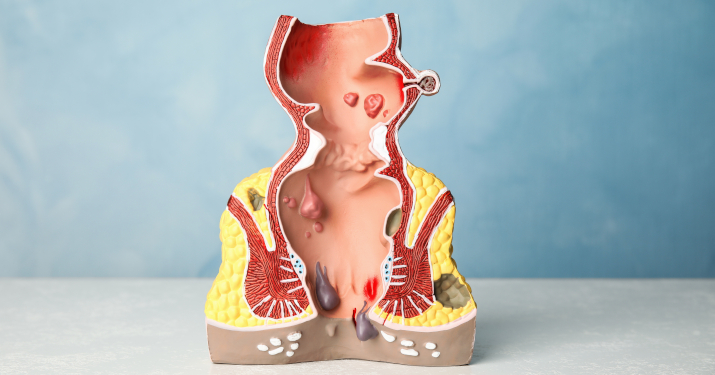 Геморрой Геморрой