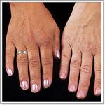 Лечение гемохроматоза