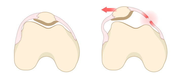 Вывих коленного сустава