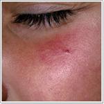 удаление сосудистых звездочек