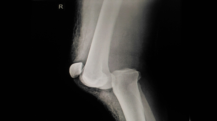 Вывих коленного сустава